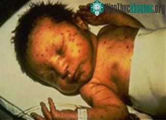 Trẻ sơ sinh bị nhiễm hội chứng Rubella bẩm sinh thường có biểu hiện: bị điếc, mù, chậm phát triển tâm thần và vận động,..