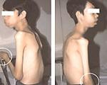 Một bệnh nhân viêm cột sống dính khớp.