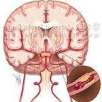 Xét nghiệm máu giúp dự báo đột quỵ ảnh 0