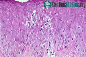 Khuẩn enterovirus 71