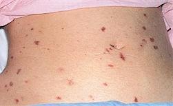 TP.HCM: Viêm não mô cầu ngấm ngầm bột phát ảnh 1