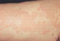 Patch Test: Xét nghiệm tìm nguyên nhân gây dị ứng ảnh 1