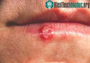 Viêm môi Herpes tái phát