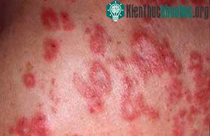 Bệnh lupus