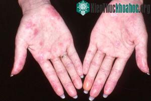 Trị bệnh lupus bằng tế bào gốc ảnh 1