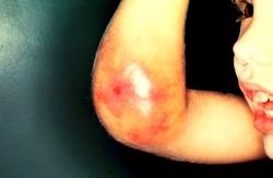 Trẻ mắc bệnh rối loạn đông máu dễ bị bầm tím...