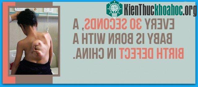 Ở Trung Quốc cứ 30 giây lại có một em bé sinh ra bị dị tật bẩm sinh.