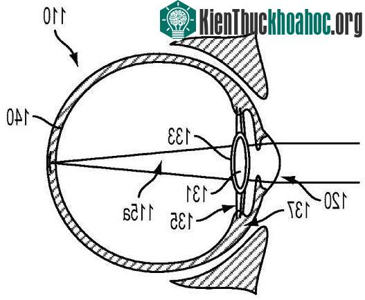 Bạn cần trải qua một cuộc phẫu thuật để bác sĩ cấy thiết bị này bao vào thủy tinh thể để hoạt động.