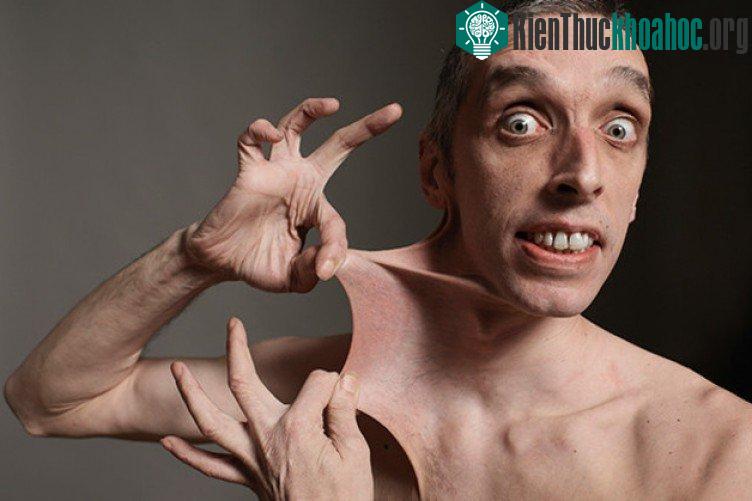 Garry Turner có làn da đàn hồi, lỏng lẻo và có tính co dãn mạnh.