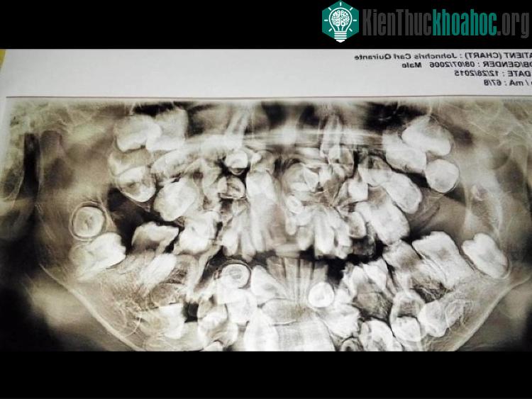Ảnh chụp số lượng răng khủng khiếp của Quirante.