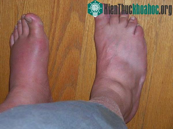 10 triệu chứng biểu hiện suy thận