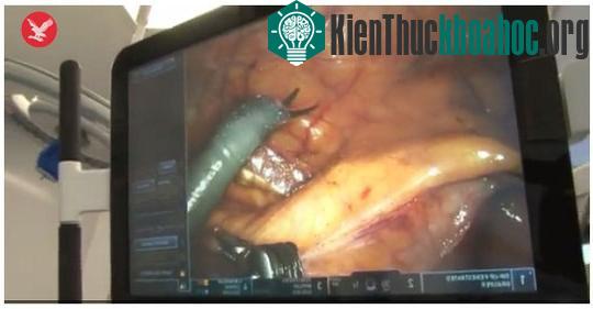Trong khi mổ ruột thừa cho một thiếu nữ người Nhật 16 tuổi, các bác sĩ đã vô tình phát hiện có một bộ não nhỏ đang phát triển cùng với xương sọ và tóc bên trong buồng trứng cô gái này. Xem thêm tại...