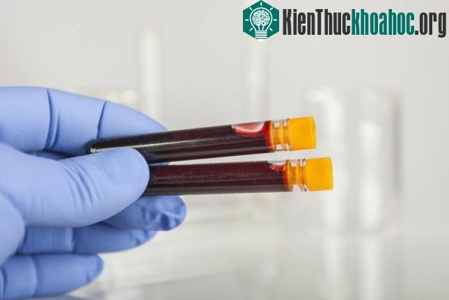 Phương pháp mới xét nghiệm chỉ cần một giọt máu.