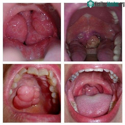 Hiểu biết đúng về ung thư vòm họng sẽ giúp mọi người biết cách phòng tránh và học cách đối mặt với loại bệnh này. Xem thêm tại đây