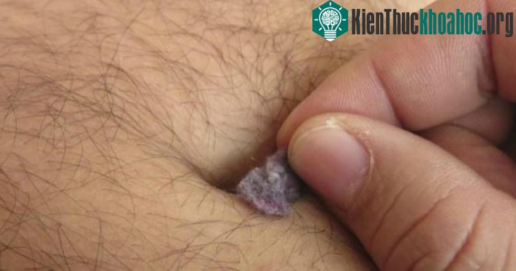 Chỉ một số người có thứ cặn bẩn này trong rốn, và thực ra thành phần của nó cũng đủ để khiến bạn bất ngờ. Xem thêm tại đây