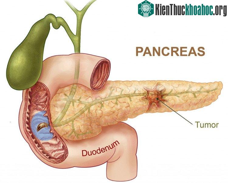 Những dấu hiệu nhận biết nguy cơ ung thư tụy ảnh 1