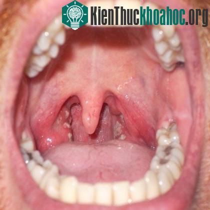 Viêm họng do liên cầu.