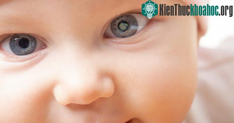 Bệnh nhân mắc đục thủy tinh thể.