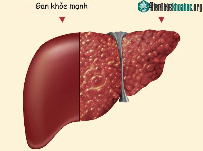 Viêm gan - sát thủ ngầm cực nguy hiểm với sức khoẻ của chúng ta.