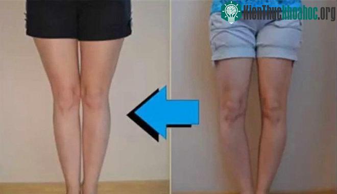 Ở người bị chân vòng kiềng 2 đầu gối chìa ra trong khi mắt cá chân chụm lại và bàn chân hướng thẳng về phía trước.