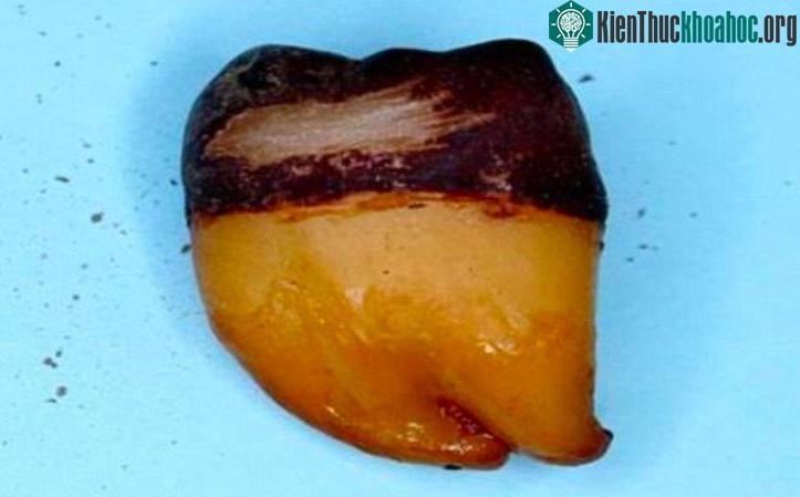 Chiếc răng khôn chuyển màu vàng ố rồi đen kịt dưới tác động của nước ngọt. (Ảnh: Tiến sĩ Tom Bierman).