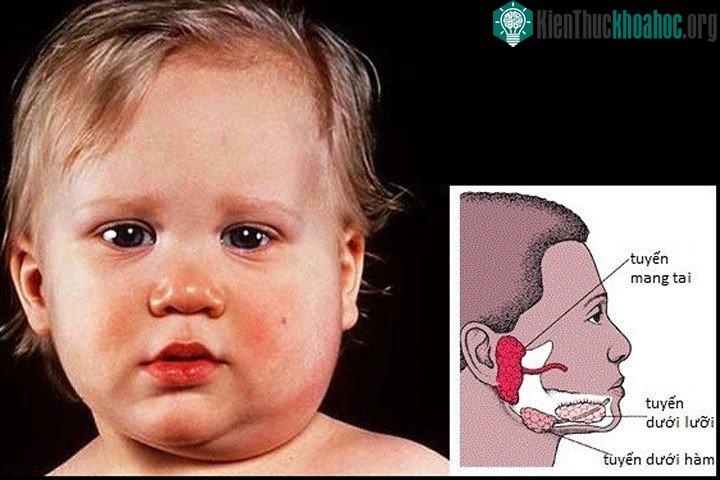 Trẻ bị quai bị, tuyến dưới hàm sẽ sưng phồng lên.