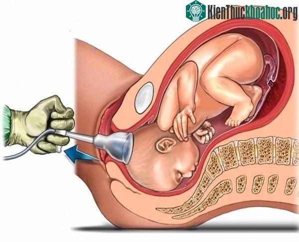 Sinh thường cực kì đau đớn và căng thẳng cho người mẹ.