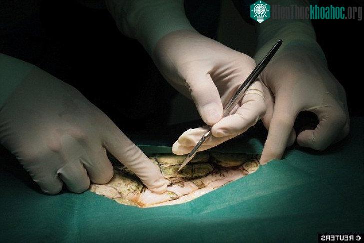 Ca mổ kéo dài 4 tiếng.
