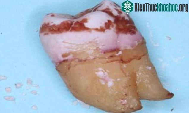 Bề mặt răng có nhiều đường nứt gãy. (Ảnh: Tiến sĩ Tom Bierman).