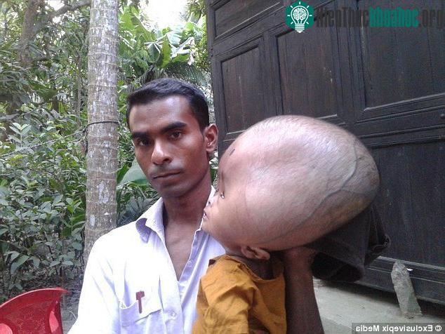 Biểu hiện lâm sàng của não úng thủy thay đổi rất khác nhau tùy từng trường hợp.