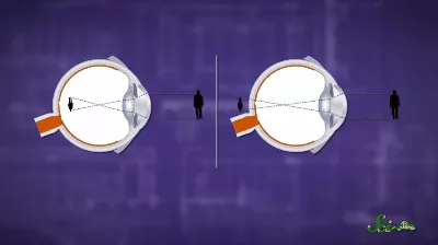 Cận thị và viễn thị.