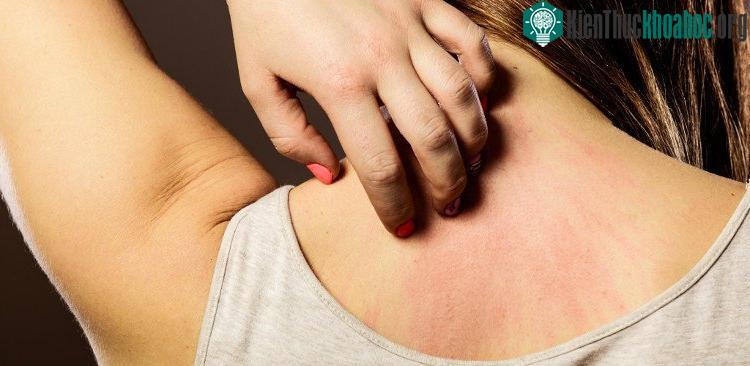 Hệ miễn dịch sẽ tập trung ở nơi bị ung thư nên khiến da bạn bị ngứa hoặc thay đổi màu sắc.