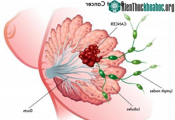 Ung thư vú là một trong những bệnh ung thư hàng đầu nên tầm soát.