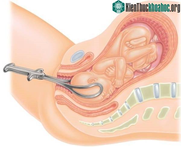Đôi khi bác sĩ phải dùng dụng cụ trợ sinh là nẹp và ống hút để đưa em bé ra.