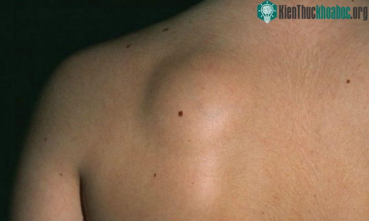 Thường xuyên kiểm tra cơ thể để xem có sự bất thường gì dưới da không.