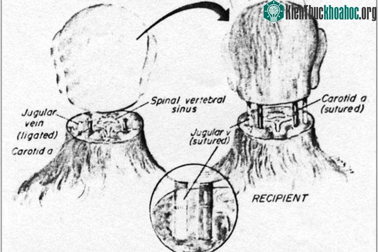 Valery Spiridonov, một người đàn ông Nga 30 tuổi đã trở thành người đầu tiên trên thế giới tình nguyện tham gia một ca cấy ghép đầu, tức là gắn đầu của mình vào một thân thể khác để chữa căn bệnh h...
