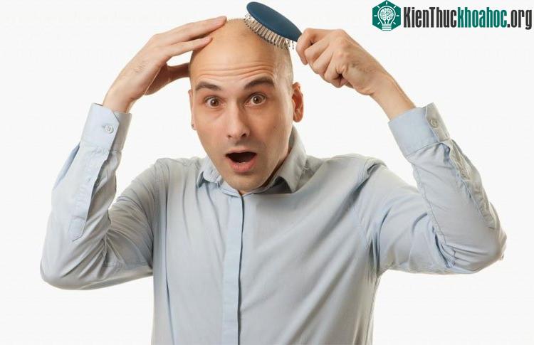 Hói đầu,bạc tóc, nỗi khổ tâm không của riêng ai.