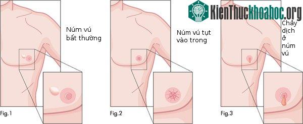 Bất thường trên da: Nếu thấy da vú có dấu hiệu không bình thường như bị lõm vào, hay tụt vào trong như lúm đồng tiền cũng phải lưu ý theo dõi và đi khám.