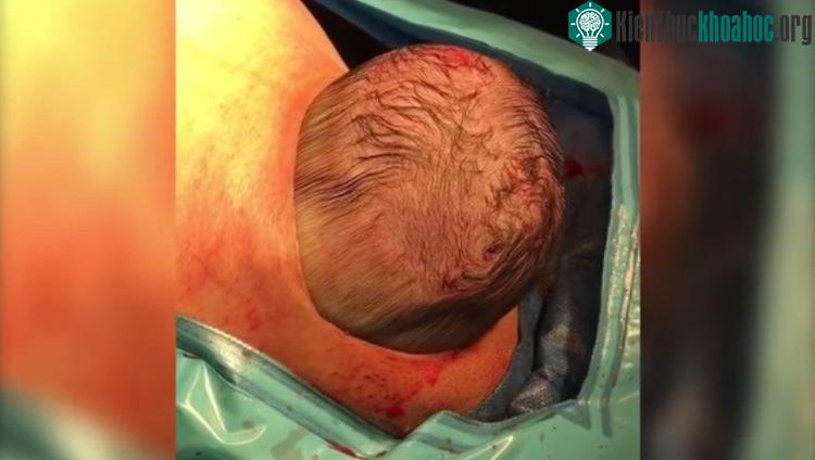 Em bé tự di chuyển chui ra khỏi bụng mẹ.
