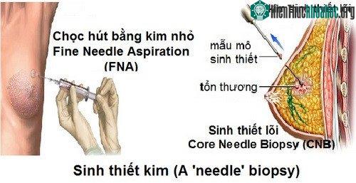  Sinh thiết xét nghiệm ung thư vú. 