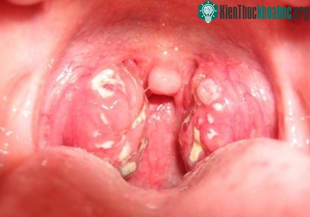 Ung thư vòm họng là dạng ung thư hiếm đối với các quốc gia phương Tây.