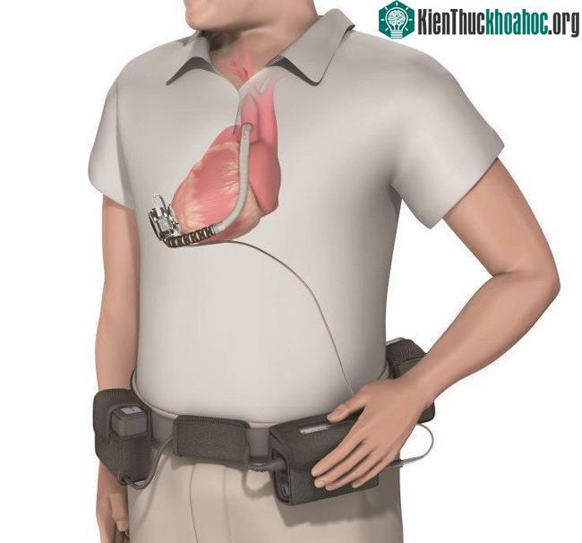 Ở phía ngoài cơ thể, người bệnh sẽ được trang bị một bộ thu phát sóng và một cục pin cầm tay nhỏ.