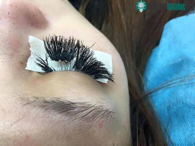 Mi quá dày, mọc quá sát rìa mắt... có thể gây kích ứng mắt, và giảm thị lực. (ảnh minh họa).