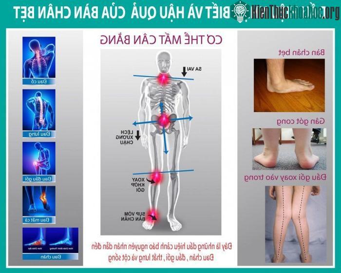 Dấu hiệu của hội chứng bàn chân bẹt