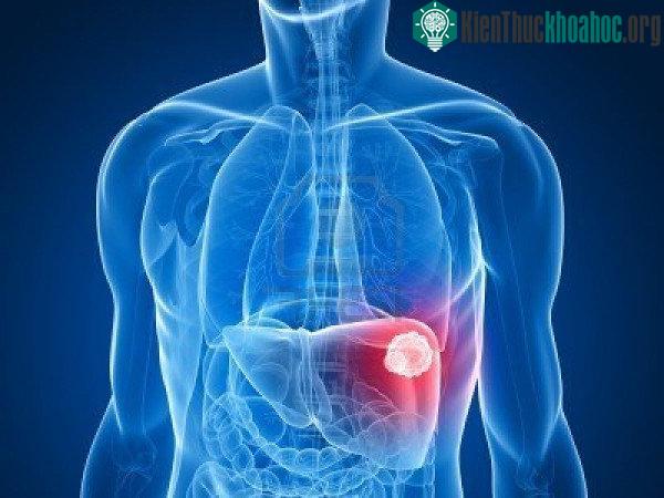 Nghiện rượu nặng là một trong những yếu tố nguy cơ đối với ung thư gan.