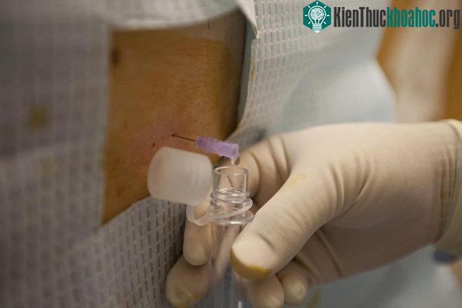 Một xét nghiệm chọc tủy sống có thể chẩn đoán được viêm não tự miễn.