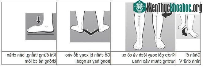 Chúng ta có thể nhìn bé từ phía sau thấy lõm bàn chân sụp vào bên trong, chân xòe ra, bị đổ dồn về phía sau hoặc chân bị lệch.