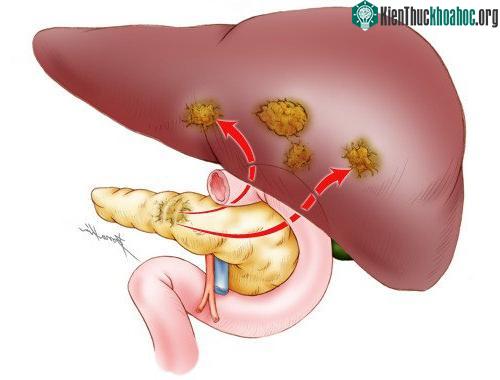 Ung thư tuyến tụy rất nguy hiểm vì diễn biến âm thầm, không gây ra triệu chứng.