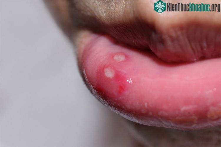 Trong niêm mạc miệng xuất hiện một hoặc nhiều đốm trắng to 1 – 2 mm.