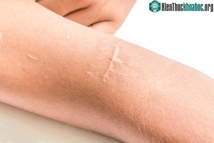 Vết sẹo trên da mà chúng ta thường thấy.